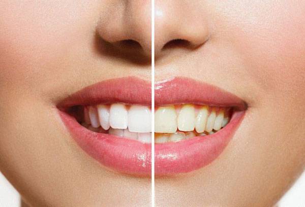 Teeth whitening results